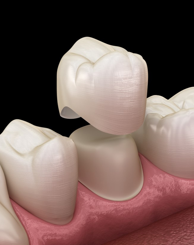 Dental Crowns Procedure in Cochrane, AB - Grande Dentistry