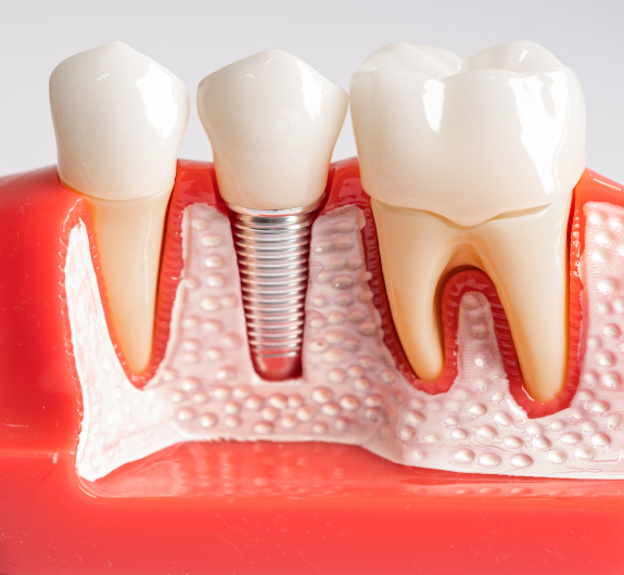 Dental Implants - Dental Services in Cochrane, AB - Grande Dentistry