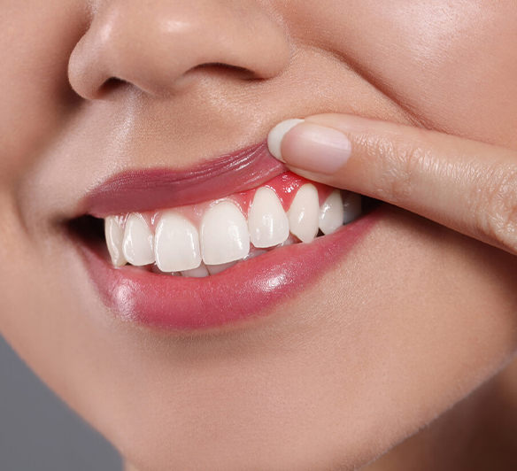 Gum Swelling - Dental Emergencies in Cochrane, AB - Grande Dentistry