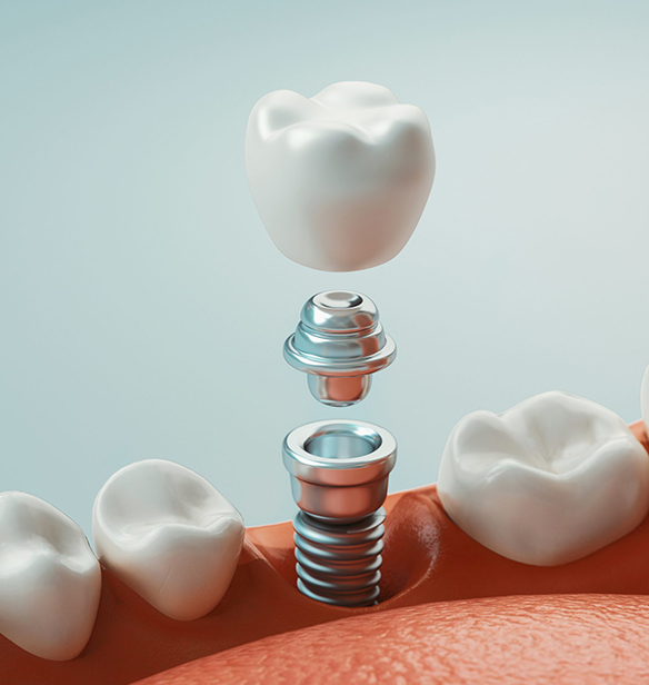 Single Tooth Implant in Cochrane, AB - Grande Dentistry