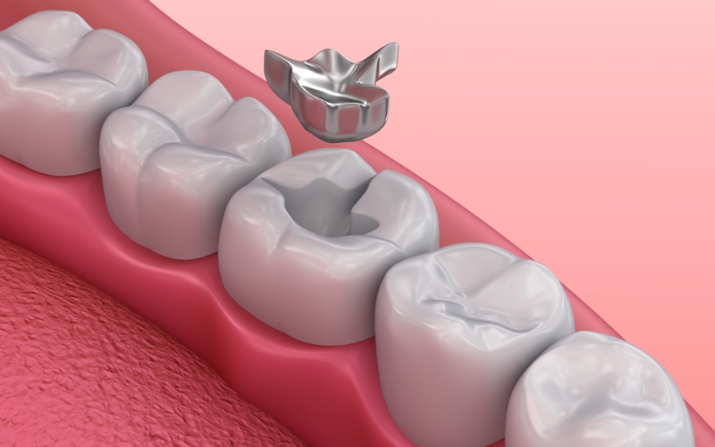 Debunking Common Myths About Dental Fillings