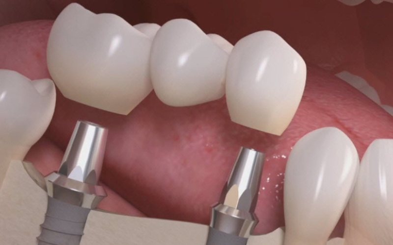 How To Clean Around A Dental Bridge