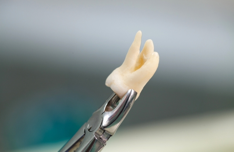 signs that indicate you need wisdom teeth removal