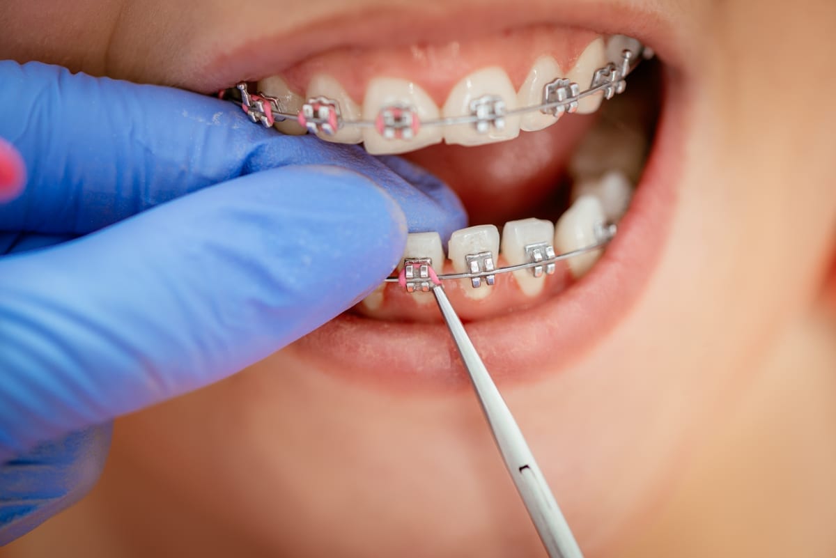 Dental Bridges in Cochrane